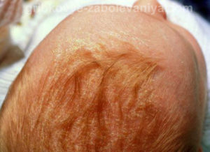 Себорея волосистой части головы
