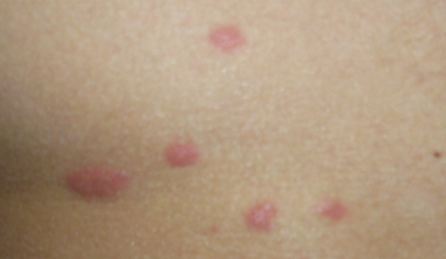 Все причины почему появляется сыпь в виде комариных укусов,Post navigation