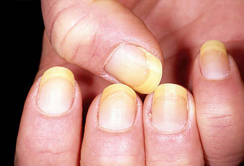 Желтые пятна на ногтях могут свидетельствовать о грибках