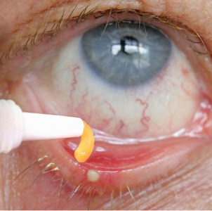Первая помощь и лечение химического ожога глаза