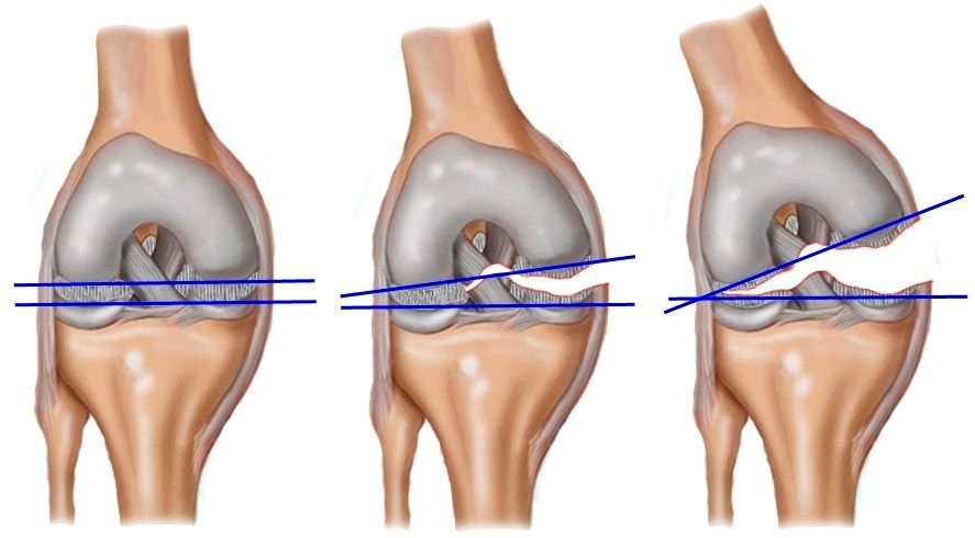 Мениск коленного сустава – функции, травмы, диагностика, лечение