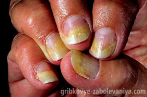 Ониходистрофия ногтей вызванная грибком