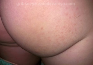 Себорейный дерматит на попе у ребенка фото