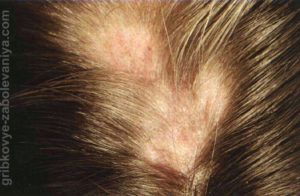 Частичное выпадение волос у мужчины на голове