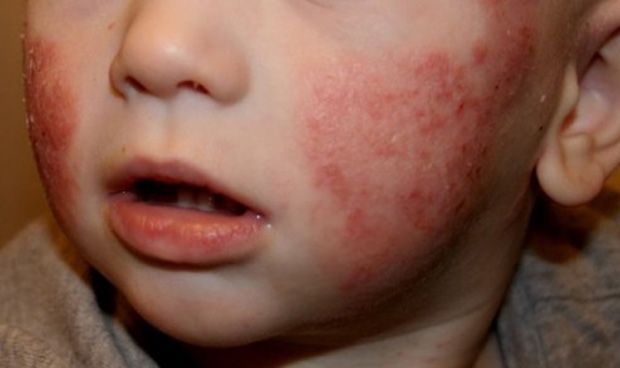 Атопический дерматит - заболевание с аллергической природой