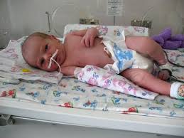 Как лечится врожденная пневмония у новорожденных
