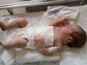 врожденная пневмония у новорожденных