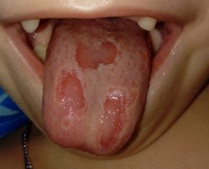 Сыпь на языке может быть вызвана разными причинами