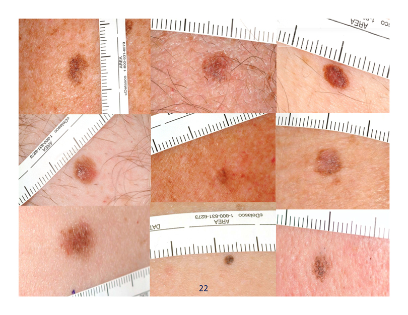 Как выглядит меланома кожи и как она проявляется | 1-female