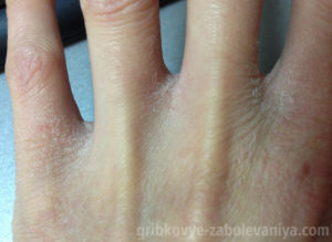 Трещины между пальцами