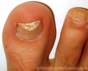 Онихомикоз - грибок ногтя