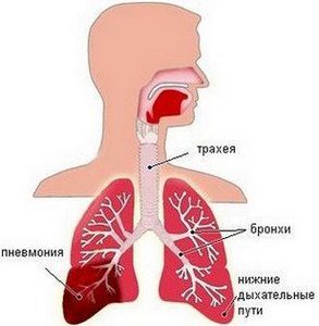 Крупозная пневмония