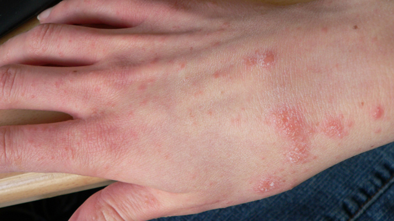Аллергическая сыпь на руках появляется по разным причинам