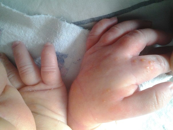 Сыпь у новорожденного на руке