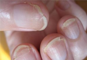 Трещины на ногтях рук причины и лечение,Post navigation