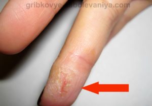 Трещины на коже пальцах рук — экзема