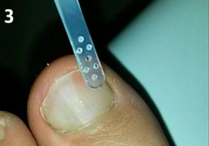 После механической обработки ногтя наносим противогрибковый лак специальной пипеткой.