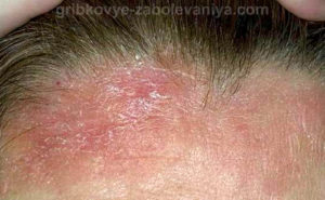 Сухой себорейный дерматит на голове