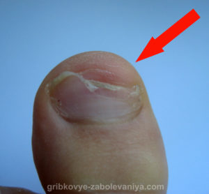 Отслоение ногтя на большом пальце ноги у ребенка