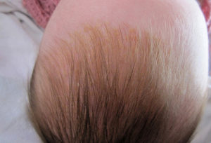 У ребенка на голове появись желтые корочки что это?,Post navigation