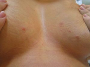 Сыпь на груди часто встречается у женщин