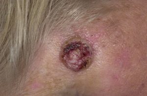 Плоскоклеточный рак кожи - онкологическая опухоль