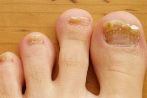 Как отличить грибок ногтей от других заболеваний,Post navigation