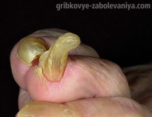 Онихогрифоз на ногтях ног 