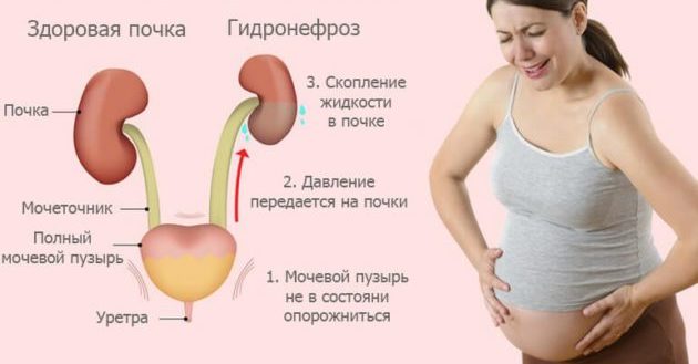 Болезни мочевыводящих путей во время беременности