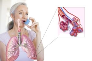 Особенности астмы у взрослых