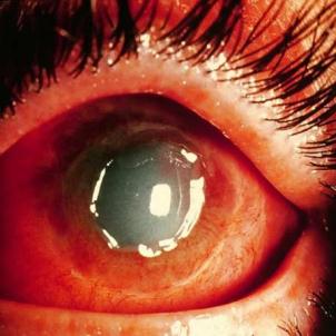 Что предпринять при ожоге глаз излучением кварцевой лампы — доврачебная помощь и лечение