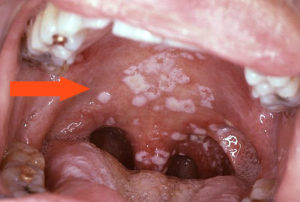 Кандидозный фарингит в ротовой полости