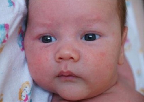 Сыпь на лице у новорожденного,Post navigation