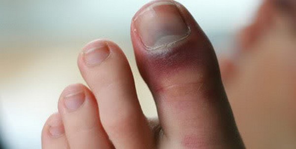 Как вылечить ушиб большого пальца на ноге