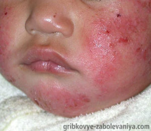 Атопический дерматит у ребенка фото