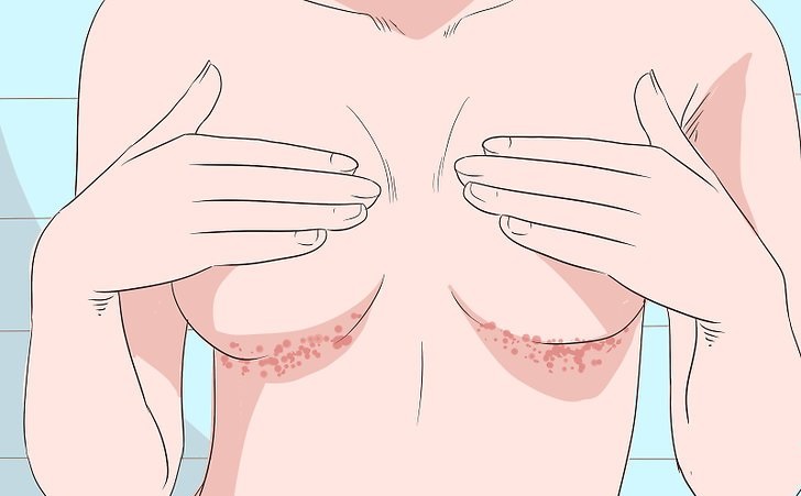 Пигментные пятна часто появляются под грудью