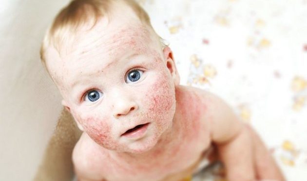 Себорейный дерматит у детей — опасен ли он