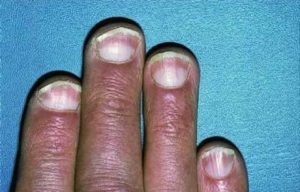 Белые пятна на ногтях рук что это означает?,Post navigation