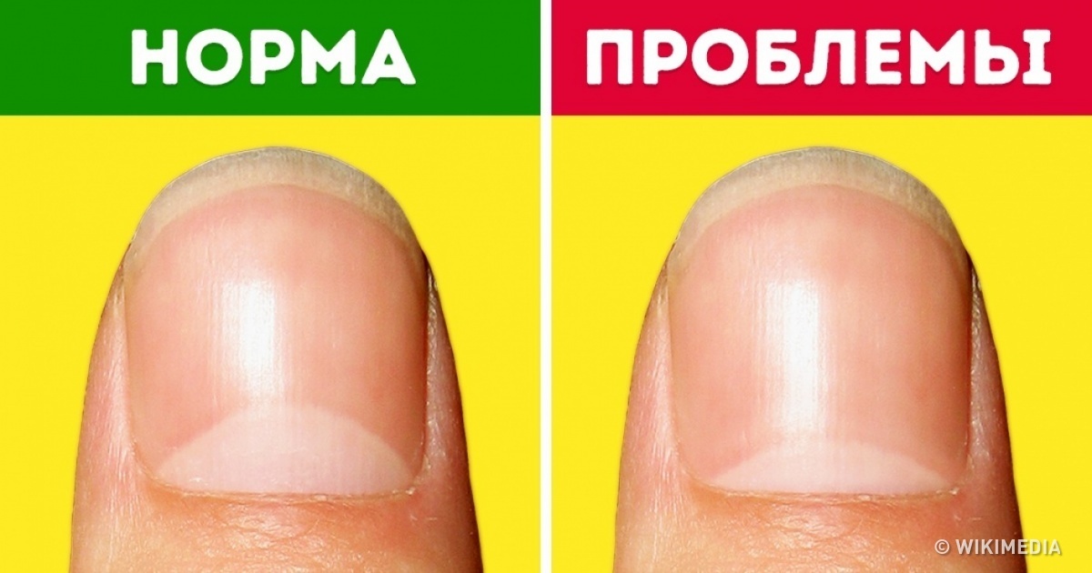 Что означают лунки на ногтях рук и их проблемы,Post navigation