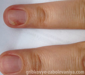 Грибок ногтя на пальце руки