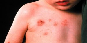 Инфекционный дерматит фото, причины, симптомы и лечение,Post navigation