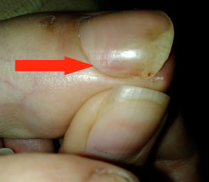 Онихолизис на ногтях руки