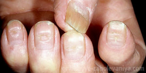 Бугристые ногти на руке