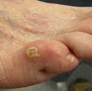 Как избавиться от сухой мозоли на пальце ноги?