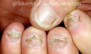 Онихомикоз - грибок на ногтях