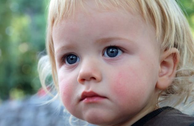 Диатез на щеках у ребенка: проявление, причины, лечение