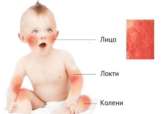 Симптомы дерматита у детей