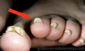 Онихомикоз — грибок на ногтях