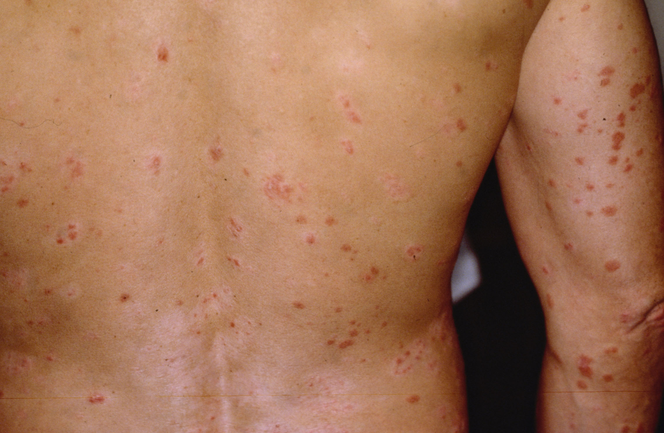 Красные точки на теле могут быть симптомом разных болезней