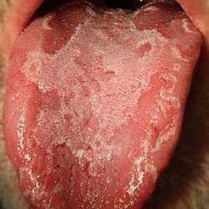 Виды, симптомы и методы лечения ожогов языка